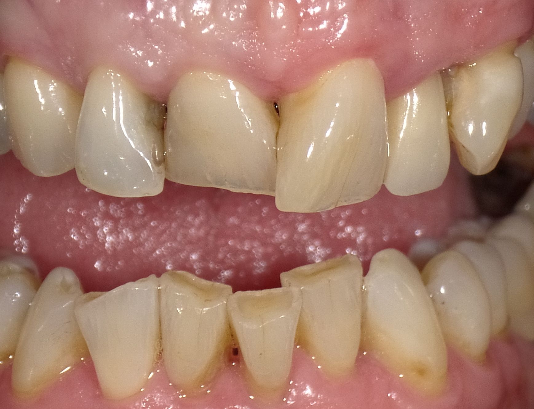 Unschöne Oberkiefer-Front